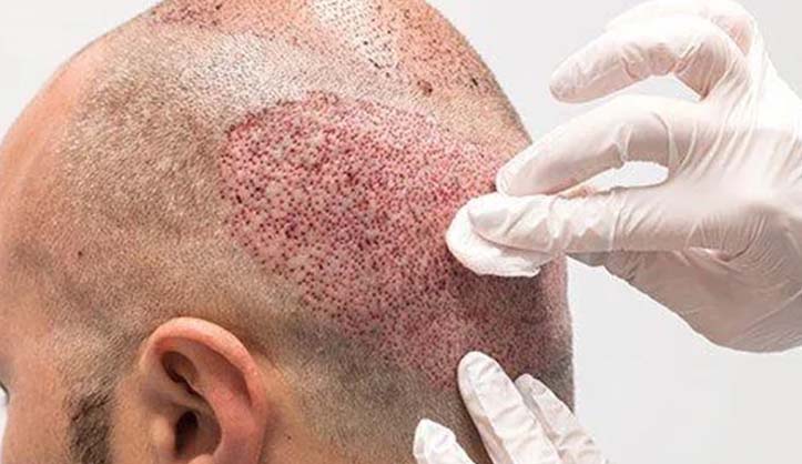 نصائح بعد زراعة الشعر بيسيريا المنطقة المانحة