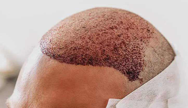 نصائح بعد زراعة الشعر بيسيريا المنطقة المزروعة